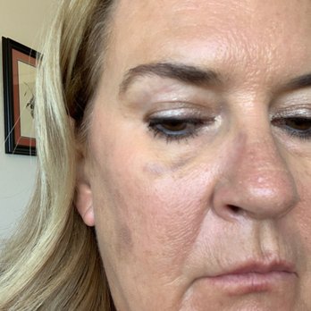 Alani Skin MD - This is 10 days later and still not gone. Shrunk, but not gone. What a nightmare. - Skin Care Near Me - Mesa, Arizona Alani Skin MD - This is 10 days later and still not gone. Shrunk, but not gone. What a nightmare. - Skin Care Near Me - Mesa, Arizona