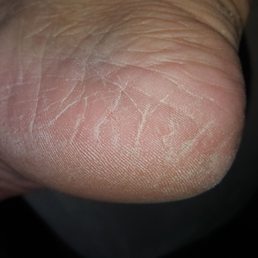 My feet 1 hour after leaving. See previous post! No happy!!