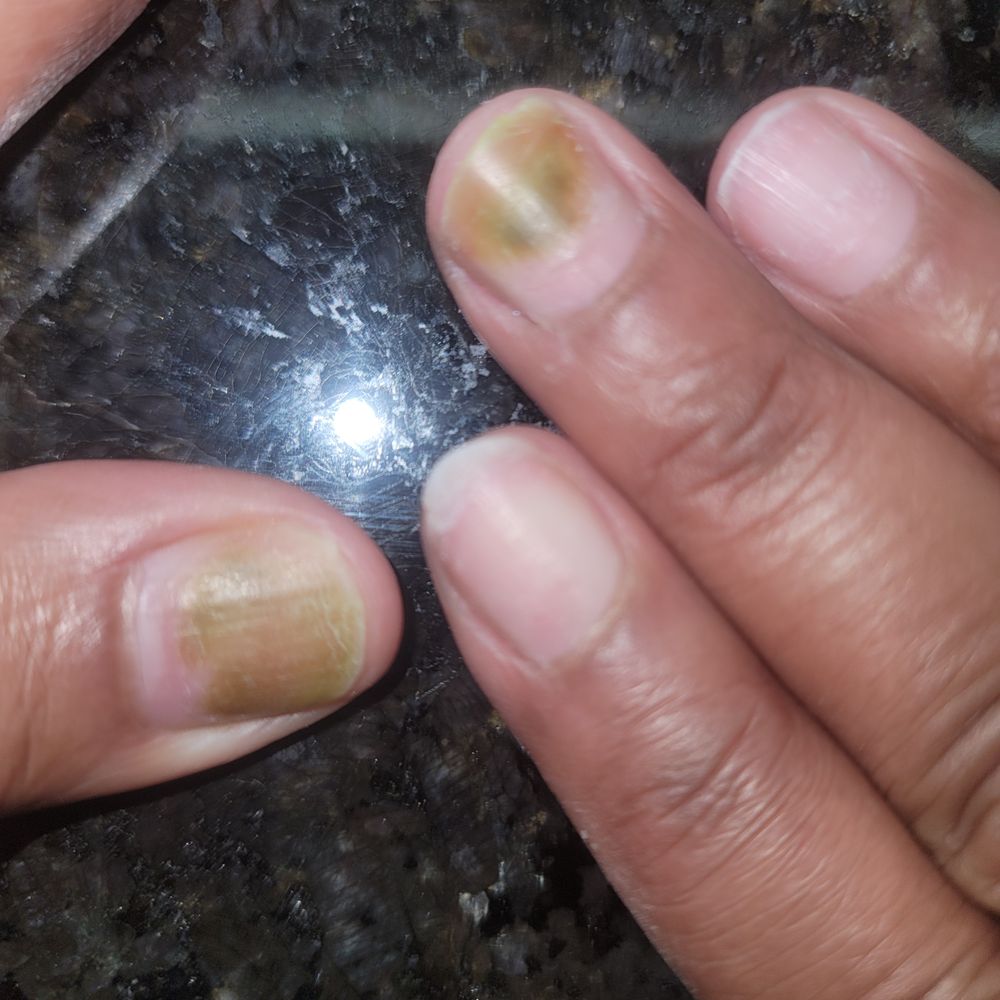 V-Star Nails - Received a Nasty Green infection from V-Star Nails in Snellville - Nail Salons Near Me - Snellville, Georgia V-Star Nails - Received a Nasty Green infection from V-Star Nails in Snellville - Nail Salons Near Me - Snellville, Georgia