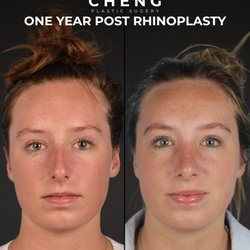 Cheng Plastic Surgery - 1 Year Post Rhinoplasty