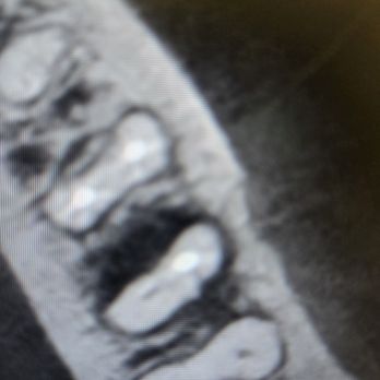 Craig D Johnson, DDS , MS, PC - Missed Canal common occurrence here - Endodontists Near Me - Portland, Oregon Craig D Johnson, DDS , MS, PC - Missed Canal common occurrence here - Endodontists Near Me - Portland, Oregon