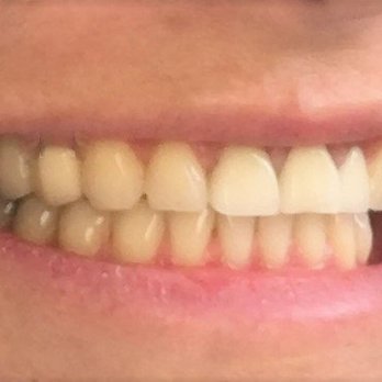 Appealing Dentistry - Orly has made my teeth and smile 150% better with beautiful bridge and crown work! - General Dentistry Near Me - Rancho Santa Margarita, California Appealing Dentistry - Orly has made my teeth and smile 150% better with beautiful bridge and crown work! - General Dentistry Near Me - Rancho Santa Margarita, California