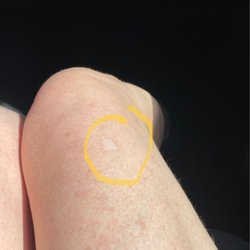South Lake Women's Healthcare - Permanent scar from laser skin tightening at South Lake Women's Health Care.
