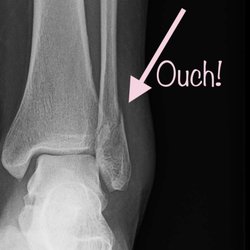 FirstMed Industrial Clinic - Salt Lake - My mildly displaced lateral malleolus fracture! Yayyyy (*sarcasm) lol