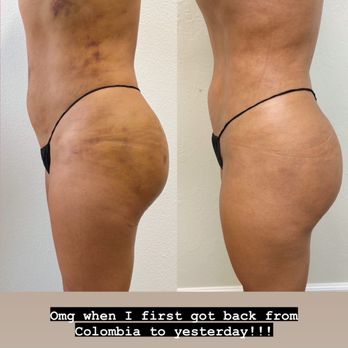 Touched by Jazz - 9 days post op vs. 3 weeks post op with the help of Jazz's massage technique! - Massage Therapy Near Me
