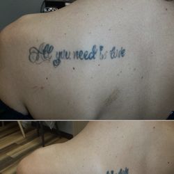 Removery Tattoo Removal & Fading