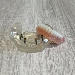 Prescott Dentures and Implants - Snap-In implants involve placing 2-4 dental implants, allowing your dentures to securely snap in and out. Also called "Snap-On Dentures".