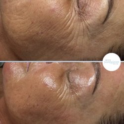 Seven Twentyseven Skincare - 1X Micro-channeling treatment