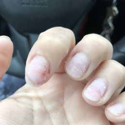 My bleeding nail