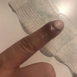 Infection from a cut in a manicure, its worse than it looks . Infection from a cut in a manicure, its worse than it looks .