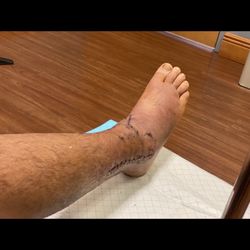 Coastal Orthopaedic & Sports Medicine Center - Post-op 1 week! Looks flawless