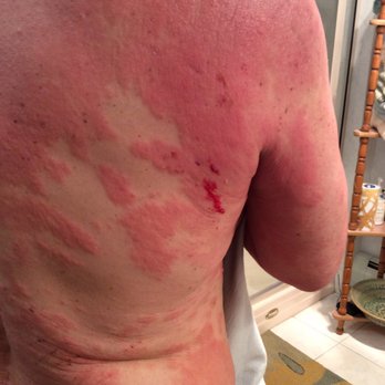 Southern Tier Dermatology - This is a before picture. - Dermatologists Near Me - Endwell, New York Southern Tier Dermatology - This is a before picture. - Dermatologists Near Me - Endwell, New York