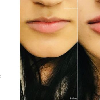 Sparrow MD - Natural Lip Enhancement - Skin Care Near Me - Vancouver, British Columbia Sparrow MD - Natural Lip Enhancement - Skin Care Near Me - Vancouver, British Columbia