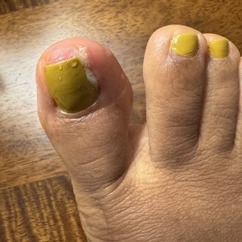 Top Nails - My infected toe with peroxide - Nail Salons Near Me - Rockville, Maryland