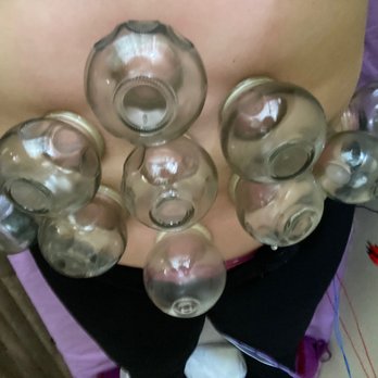Natural Acupuncture & Cupping Center - The cupping process - Traditional Chinese Medicine Near Me - Arcadia, California Natural Acupuncture & Cupping Center - The cupping process - Traditional Chinese Medicine Near Me - Arcadia, California