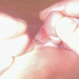 Chemical burn from pedicure service