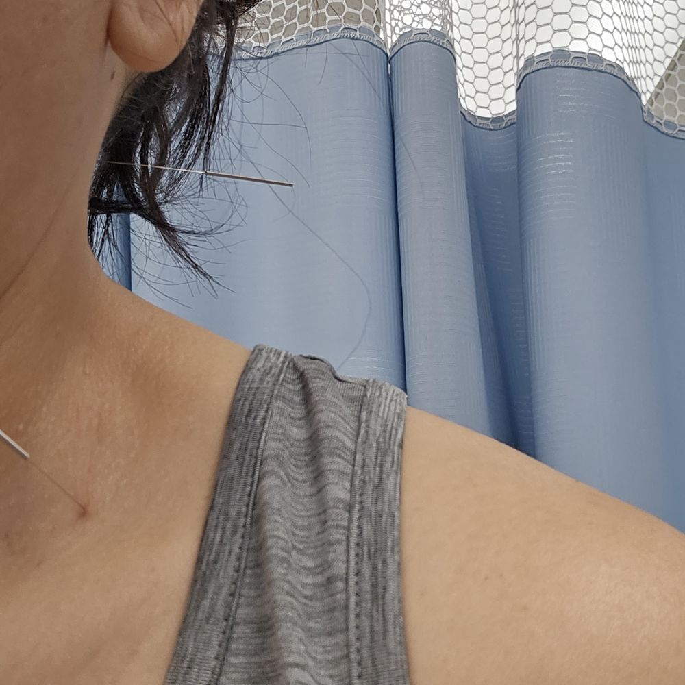 Neck and Back Acupuncture - Needles for Neck and Jaw Pain - Acupuncture Near Me - Torrance, California Neck and Back Acupuncture - Needles for Neck and Jaw Pain - Acupuncture Near Me - Torrance, California