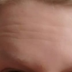 Fragen Cosmetic Surgery Center - 3 weeks after receiving 40 units of Xeomin in forehead. Not happy with the results.Botox and Dysaport worked much better for me.