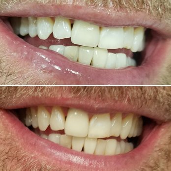 Whitenex Cosmetic Teeth Whitening - Before and after - Teeth Whitening Near Me - Costa Mesa, California Whitenex Cosmetic Teeth Whitening - Before and after - Teeth Whitening Near Me - Costa Mesa, California