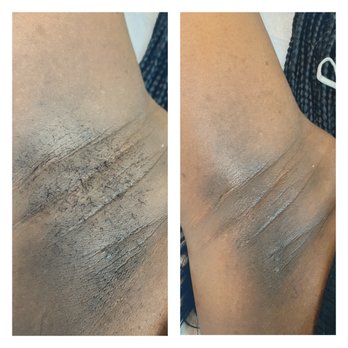 MBS Esthetics - Underarm waxing - Skin Care Near Me MBS Esthetics - Underarm waxing - Skin Care Near Me