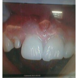 Greenwood Family Dentistry - After $5,000 for 4 Crowns,  8 mos later, Dr. Wilman offfers no remedy, apparently he s still paying student. STAY AWAY