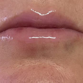 Aloha Aesthetics MD - Day 1 swelling post injections - Medical Spas Near Me - Honolulu, Hawaii Aloha Aesthetics MD - Day 1 swelling post injections - Medical Spas Near Me - Honolulu, Hawaii