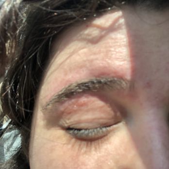 Glitzy Brows - Torn skin under brow - Hair Removal Near Me - Hermitage, Tennessee Glitzy Brows - Torn skin under brow - Hair Removal Near Me - Hermitage, Tennessee