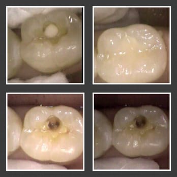 Future Dental Care - My hidden cavity. My first in over 30 years. - General Dentistry Near Me - Redwood City, California Future Dental Care - My hidden cavity. My first in over 30 years. - General Dentistry Near Me - Redwood City, California