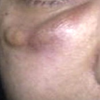 Dr. Yates Lifestyle Med - under eye filler her associated messed up and CHARGED ME TO GET FIXED. So I had to go to a board certificates surgeon to get this fixed. - Medical Spas Near Me - Chicago, Illinois Dr. Yates Lifestyle Med - under eye filler her associated messed up and CHARGED ME TO GET FIXED. So I had to go to a board certificates surgeon to get this fixed. - Medical Spas Near Me - Chicago, Illinois
