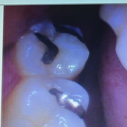 Future Dental Care - Before (my silver fillings)