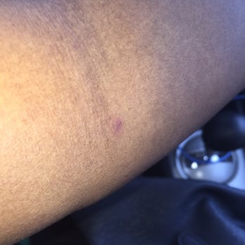 Pro Line Archery Lanes - Popped my arm - Archery Near Me - Ozone Park, New York Pro Line Archery Lanes - Popped my arm - Archery Near Me - Ozone Park, New York