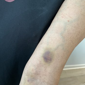 Quest Diagnostics - Blood drawn from bicep artery. Not a good practice,  ever saw anyone do that. - Laboratory Testing Near Me - St Augustine, Florida