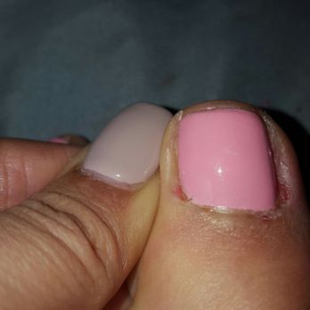 U Need Nails - Same toe and it already infected!!!! - Nail Salons Near Me - South Gate, California U Need Nails - Same toe and it already infected!!!! - Nail Salons Near Me - South Gate, California