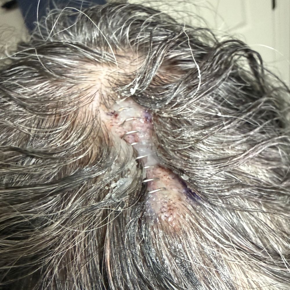 MODERN Dermatology - all stapled up, they shaved minimal King cover with my hair - Dermatologists Near Me - Scottsdale, Arizona MODERN Dermatology - all stapled up, they shaved minimal King cover with my hair - Dermatologists Near Me - Scottsdale, Arizona