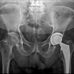 Eli Ahdoot - Minimally Invasive - Chekc out the new hip!