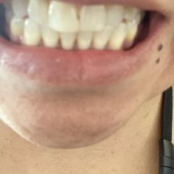 Tempe Smile Design - Front teeth one looks bigger