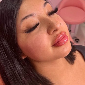 SKYN MD - Right after the injections - Medical Spas Near Me - Ontario, California SKYN MD - Right after the injections - Medical Spas Near Me - Ontario, California