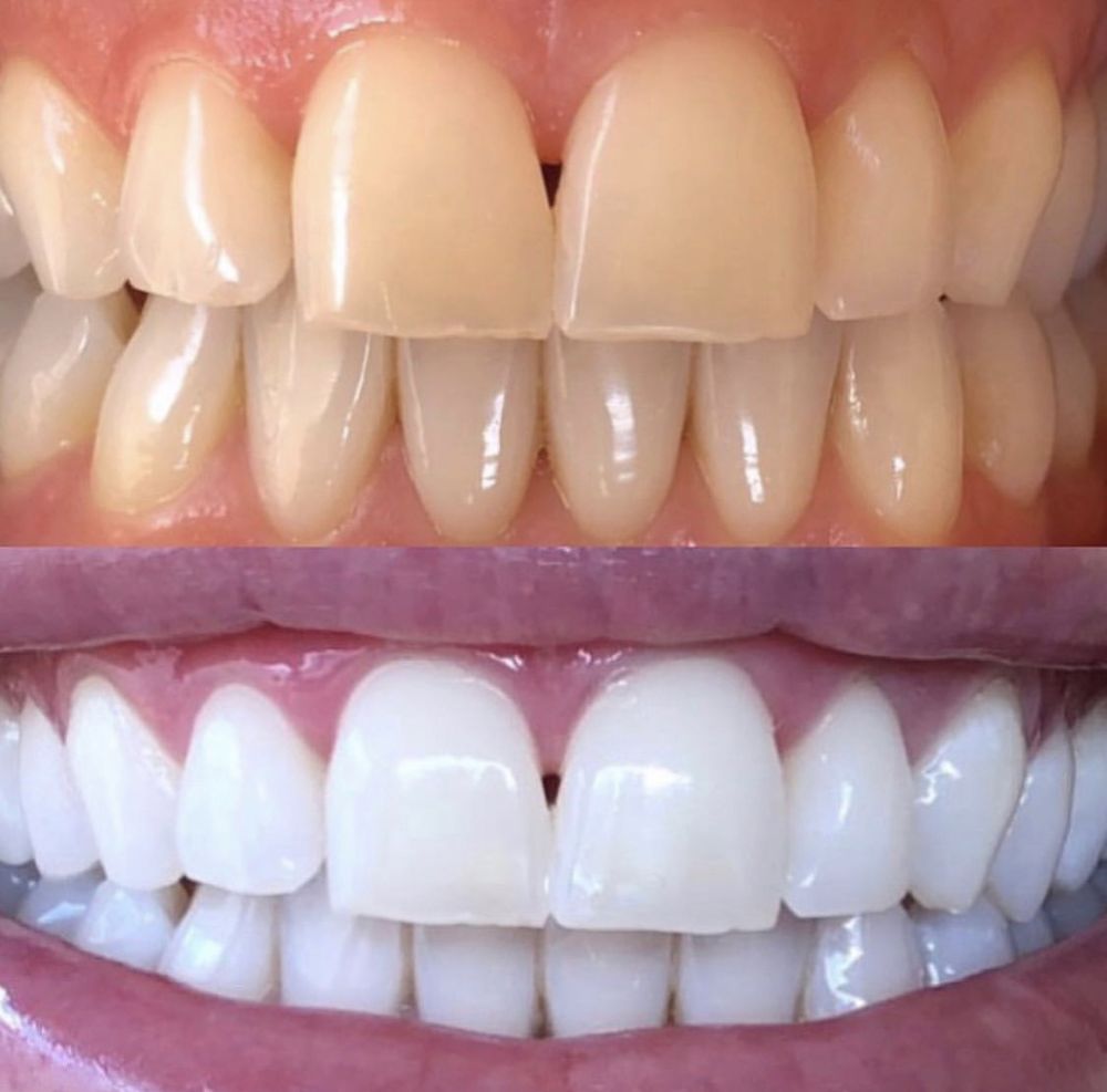 SHINE & GLO TEETH WHITENING Updated June 2024 Request an