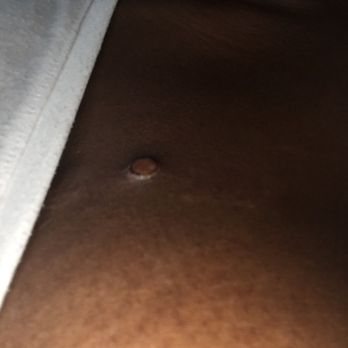 Skin Physicians & Surgeons - This was the first couple days after the PA went to "work" on me - Dermatologists Near Me - Upland, California