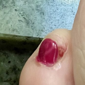 Ocean Nails & Spa - Toenail cut off of the skin down the side - Nail Salons Near Me - Goleta, California Ocean Nails & Spa - Toenail cut off of the skin down the side - Nail Salons Near Me - Goleta, California