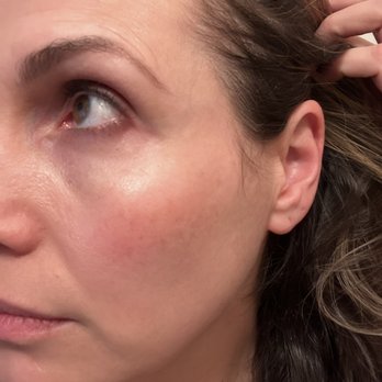 Luxe Body Wraps - After photo- less noticeable dark spots, smooth texture and less blemishes . - Day Spas Near Me - San Jose, California Luxe Body Wraps - After photo- less noticeable dark spots, smooth texture and less blemishes . - Day Spas Near Me - San Jose, California