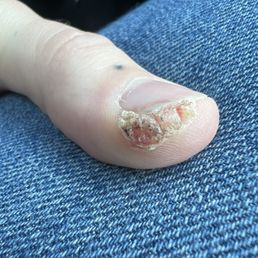 HPV periungal wart