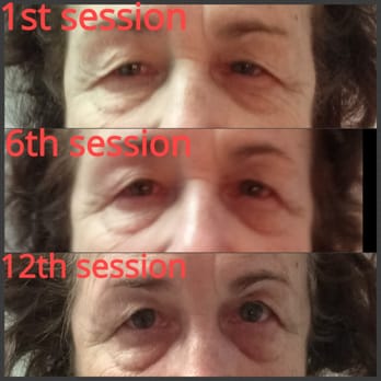 SkinVibe @ Alexanders salon - Microcurrent treatment. Best anti aging facial. My client does have eyes under those lids! - Skin Care Near Me - Las Vegas, Nevada SkinVibe @ Alexanders salon - Microcurrent treatment. Best anti aging facial. My client does have eyes under those lids! - Skin Care Near Me - Las Vegas, Nevada