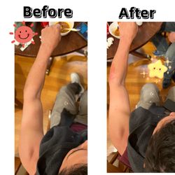 Rose Garden Acupuncture - Arm broken. Weak arm and can not hold the object steady. After one time Acupotomy can straighten the arm.