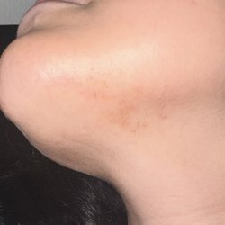 Bare Electrolysis - After 5 sessions