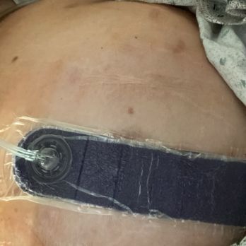 ECMC - My hernia surgery a wound vac they call it - Hospitals Near Me - Buffalo, New York