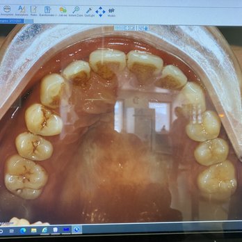 Basil Amer, DDS MS - After 7/7 trays, 3/2021 - Orthodontists Near Me - La Crescenta, California