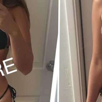 Jeff Healy, MD - 3 days Post Op. swelling has come down so I look a lot smaller now. But still NOICE - Cosmetic Surgeons Near Me - Aiea, Hawaii Jeff Healy, MD - 3 days Post Op. swelling has come down so I look a lot smaller now. But still NOICE - Cosmetic Surgeons Near Me - Aiea, Hawaii