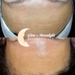 Firming V-Tox mask before and after
