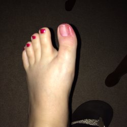 T-Nails & Tanning - Took off the polish to assess it better and my toe is so swollen I can't even lift the nail to relieve the pressure!